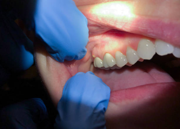 Best Broken or Cracked Tooth Emergency Dentist in Key Largo, FL